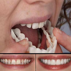 لمینت دندان دو فک مدل Snap on Smile